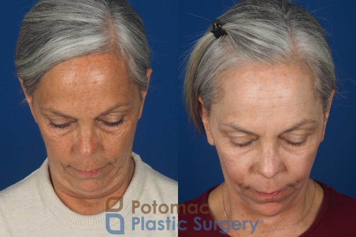 Before & After Facelift Case 363 Top View in Washington DC & Arlington , DC