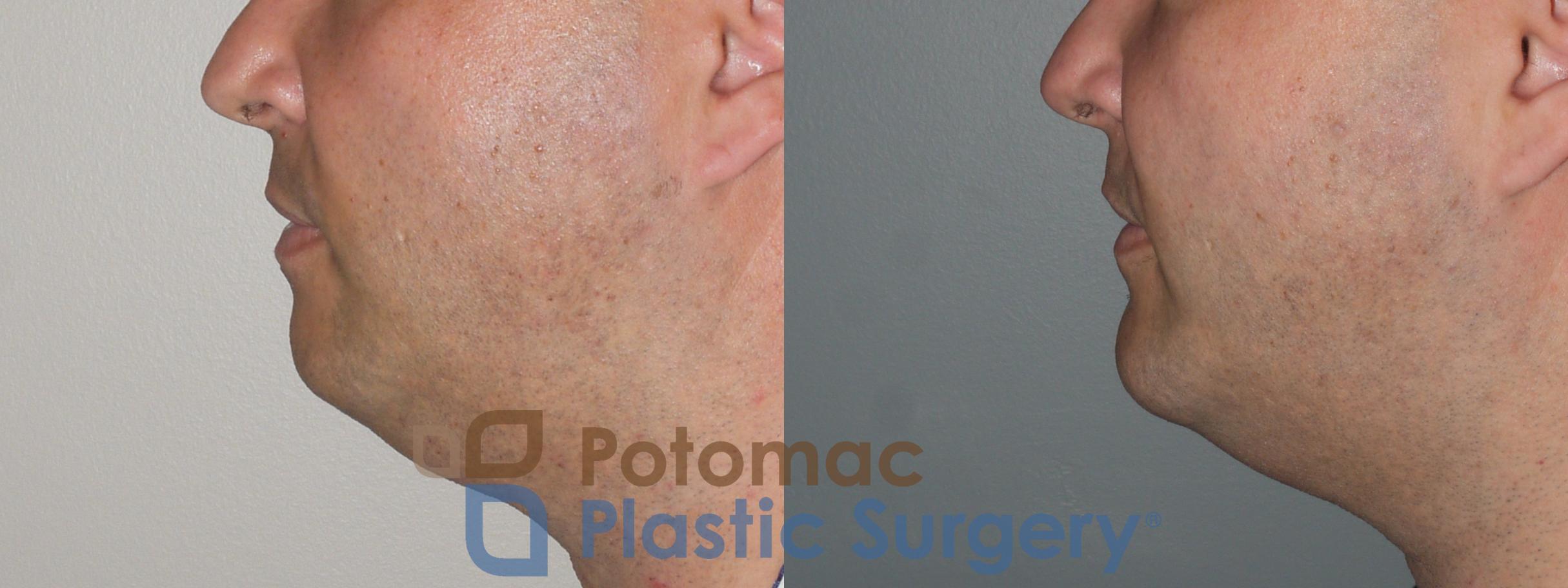 Before & After Chin Augmentation Case 111 Left Side View in Washington, DC