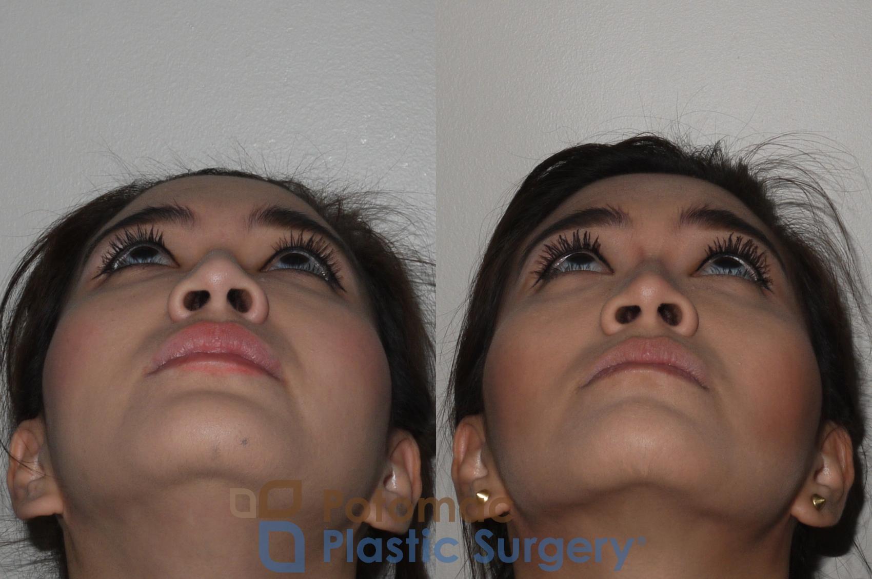Before & After Facial Sculpting Case 122 Below View in Washington, DC