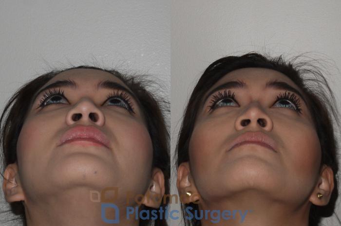Before & After Facial Sculpting Case 122 Below View in Washington DC & Arlington , DC