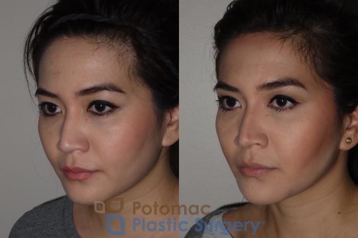 Before & After Facial Sculpting Case 122 Left Oblique View in Washington DC & Arlington , DC