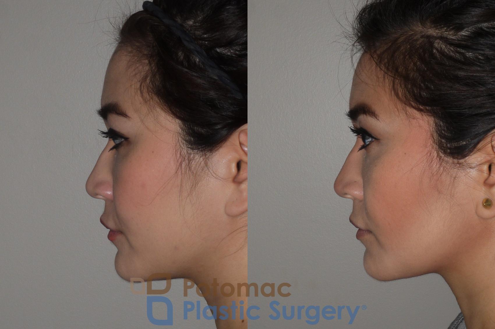 Before & After Facial Sculpting Case 122 Left Side View in Washington, DC