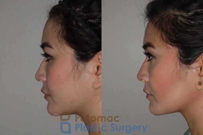 Before & After Botox Cosmetic Case 122 Left Side View in Washington, DC