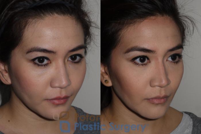 Before & After Facial Sculpting Case 122 Right Oblique View in Washington DC & Arlington , DC