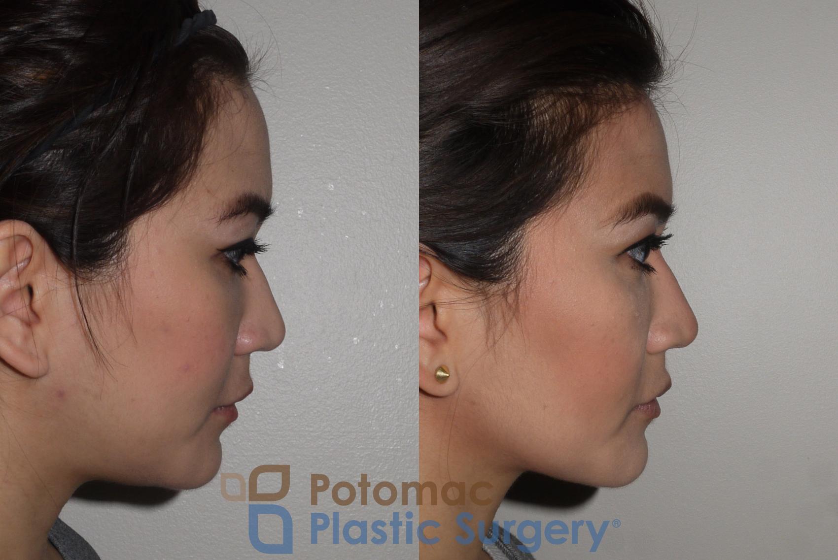 Before & After Facial Sculpting Case 122 Right Side View in Washington, DC