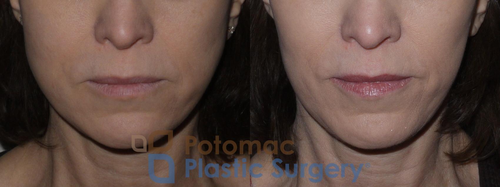 Before & After Facial Sculpting Case 123 Front View in Washington DC & Arlington , DC