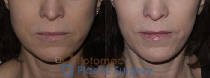 Before & After Botox Cosmetic Case 123 Front View in Washington, DC