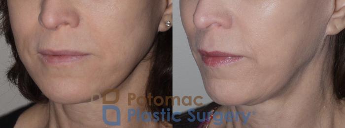 Before & After Botox Cosmetic Case 123 Left Oblique View in Washington DC & Arlington , DC