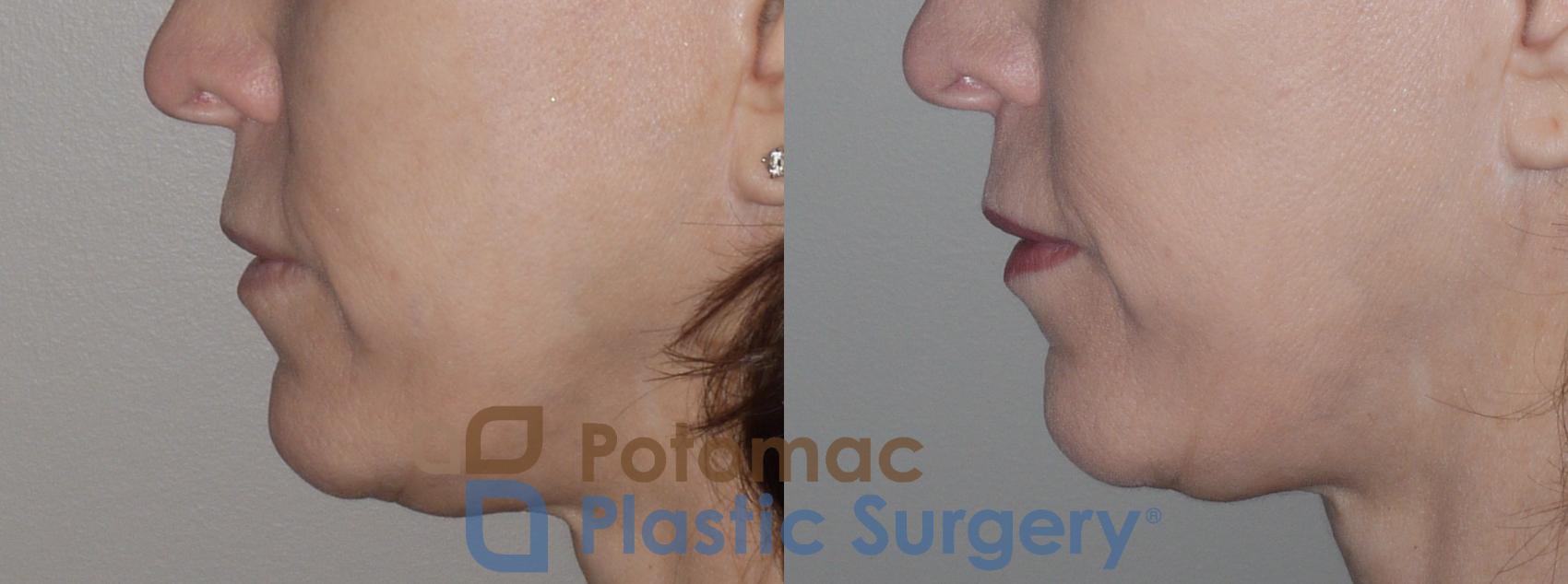 Before & After Facial Sculpting Case 123 Left Side View in Washington, DC
