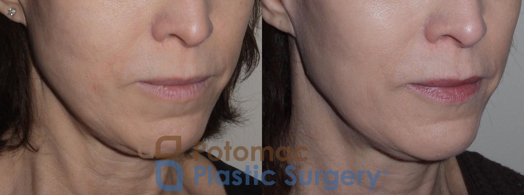 Before & After Facial Sculpting Case 123 Right Oblique View in Washington, DC