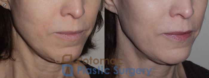 Before & After Botox Cosmetic Case 123 Right Oblique View in Washington DC & Arlington , DC