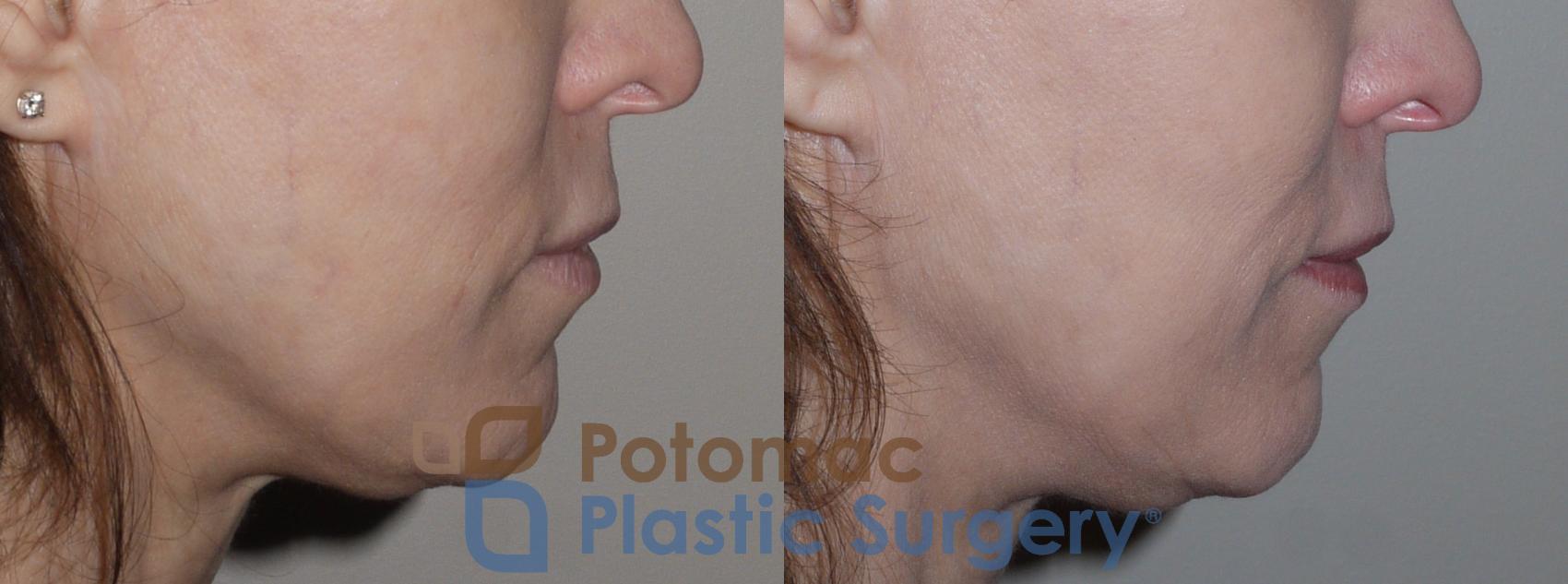 Before & After Facial Sculpting Case 123 Right Side View in Washington, DC