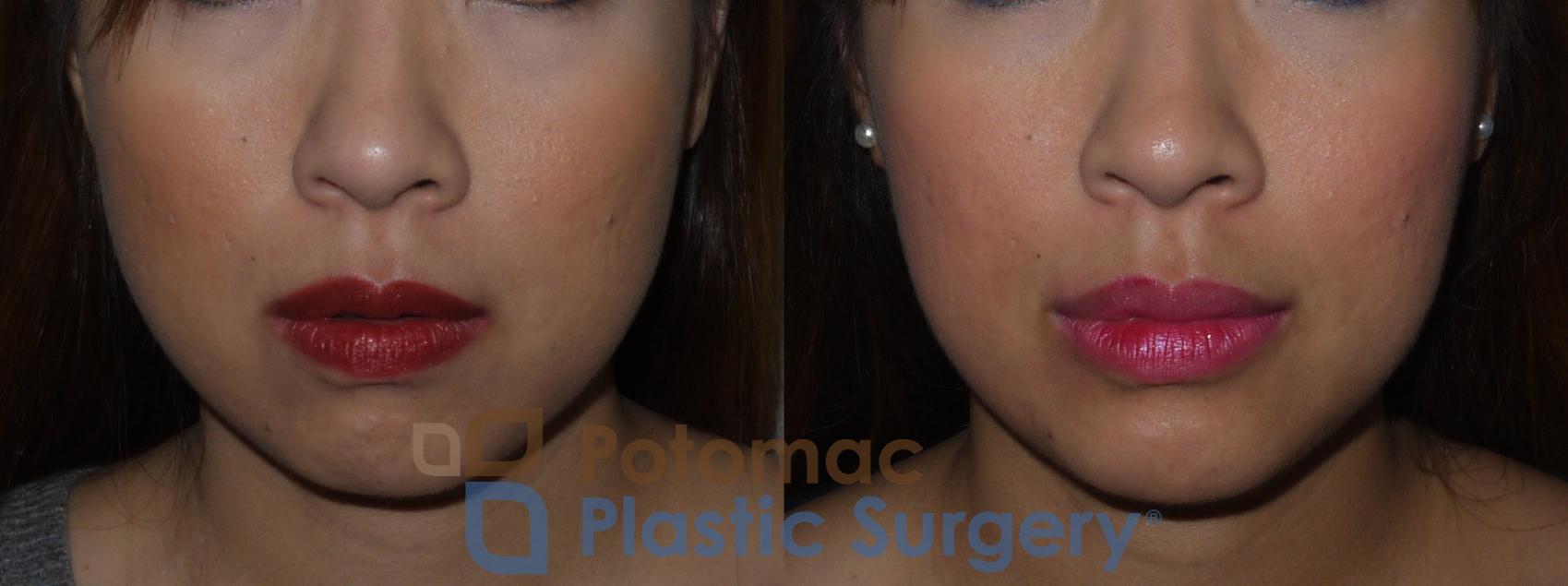 Before & After Liquid Facelift Case 131 Front View in Washington, DC