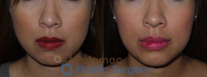 Before & After Liquid Facelift Case 131 Front View in Washington DC & Arlington , DC
