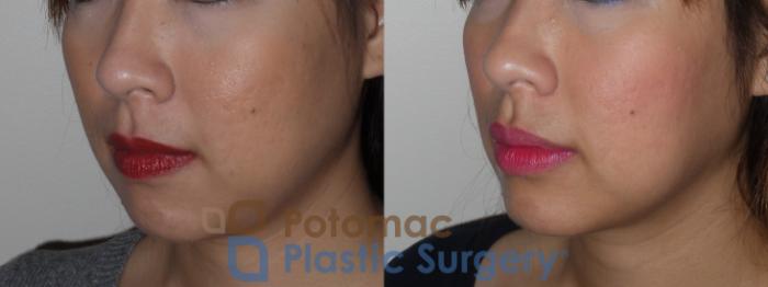 Before & After Botox Cosmetic Case 131 Left Oblique View in Washington DC & Arlington , DC