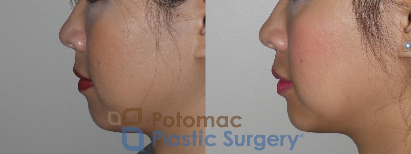 Before & After Facial Sculpting Case 131 Left Side View in Washington, DC