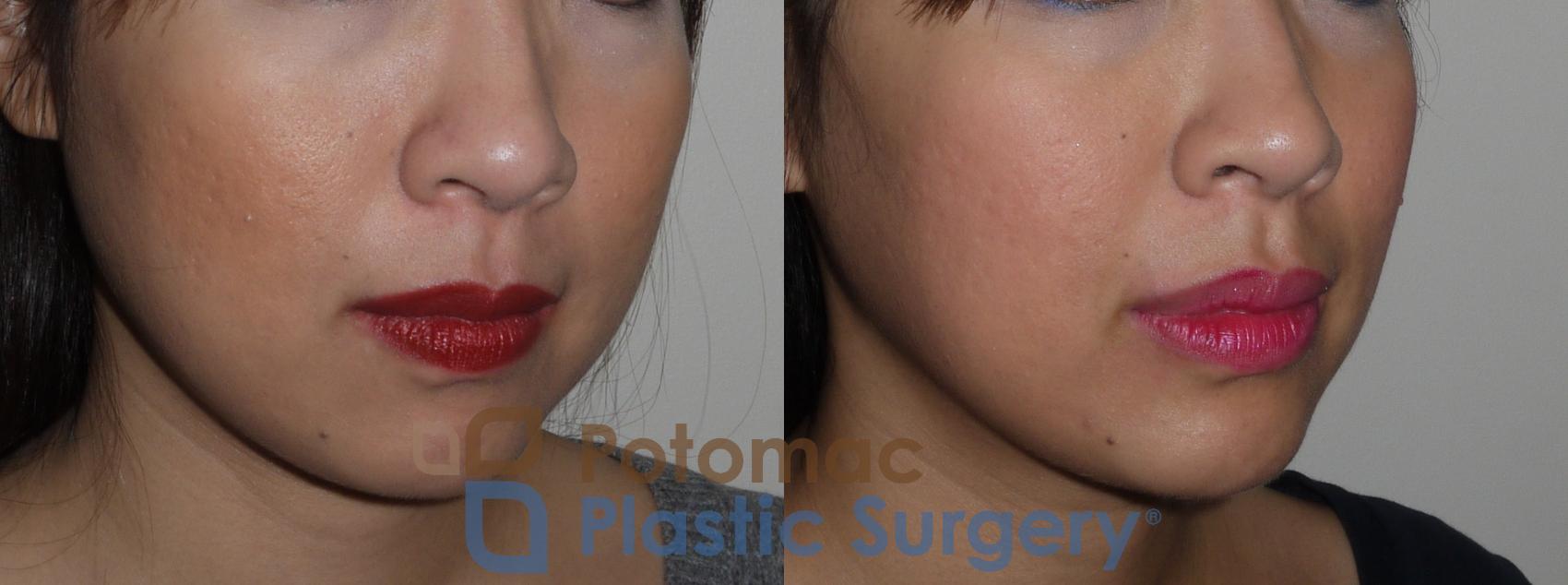 Before & After Liquid Facelift Case 131 Right Oblique View in Washington, DC
