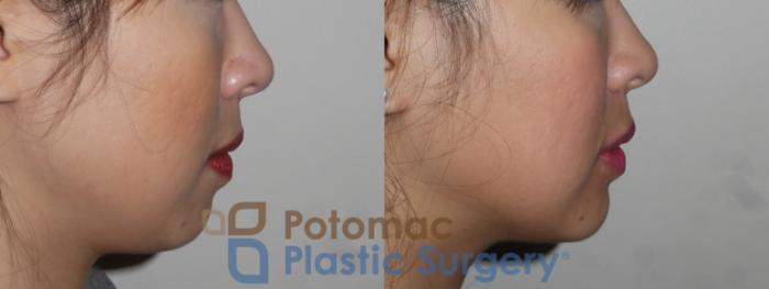 Before & After Dermal Fillers Case 131 Right Side View in Washington DC & Arlington , DC