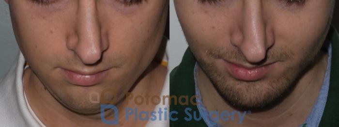 Before & After Facial Sculpting Case 135 Above View in Washington, DC