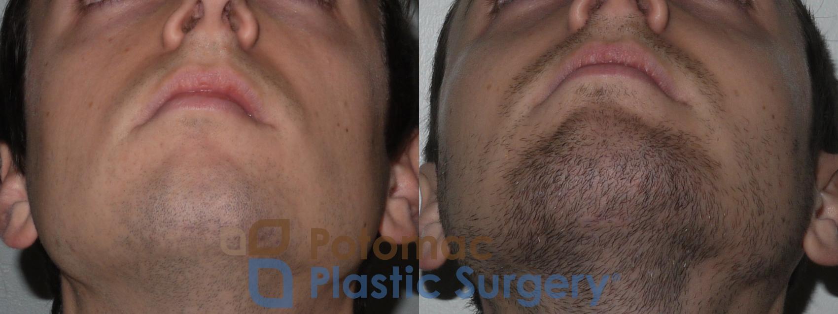 Before & After Chin Augmentation Case 135 Below View in Washington, DC