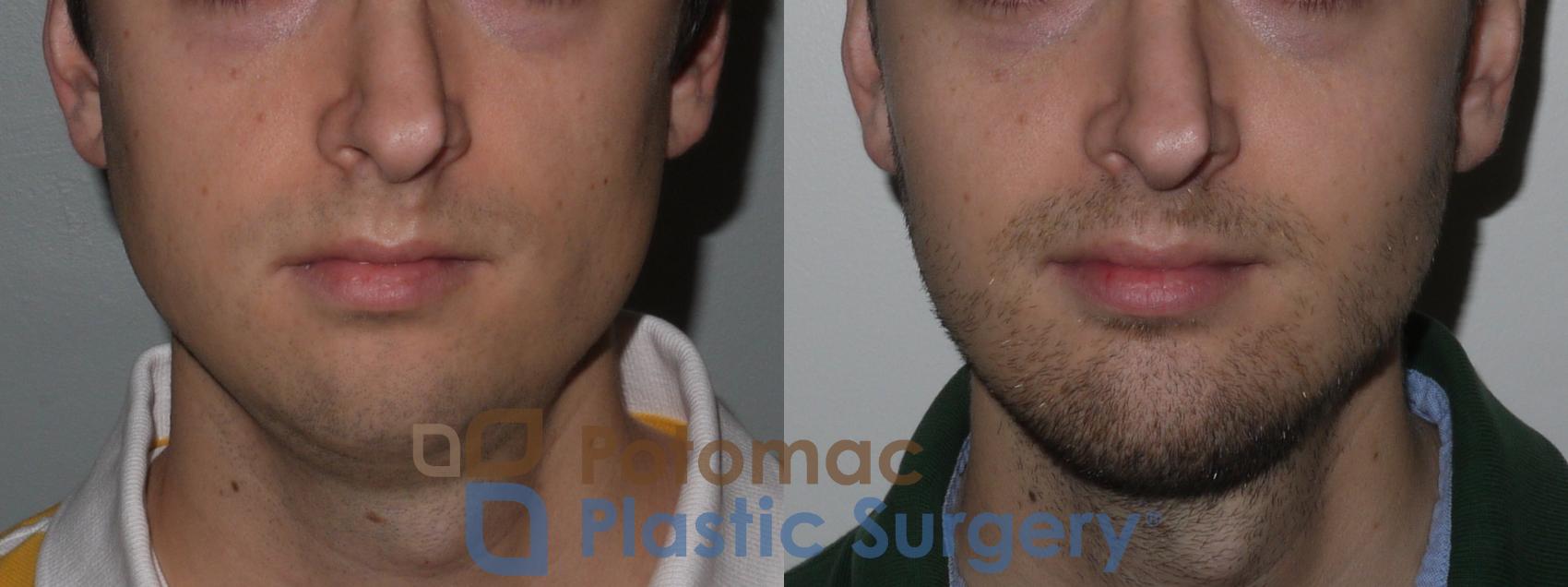 Before & After Chin Augmentation Case 135 Front View in Washington, DC