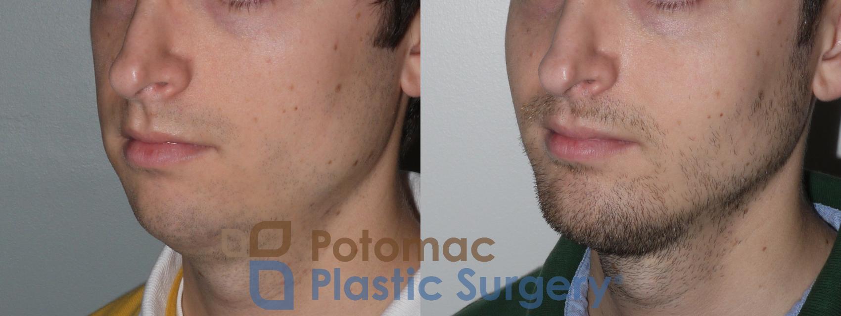 Before & After Chin Augmentation Case 135 Left Oblique View in Washington, DC