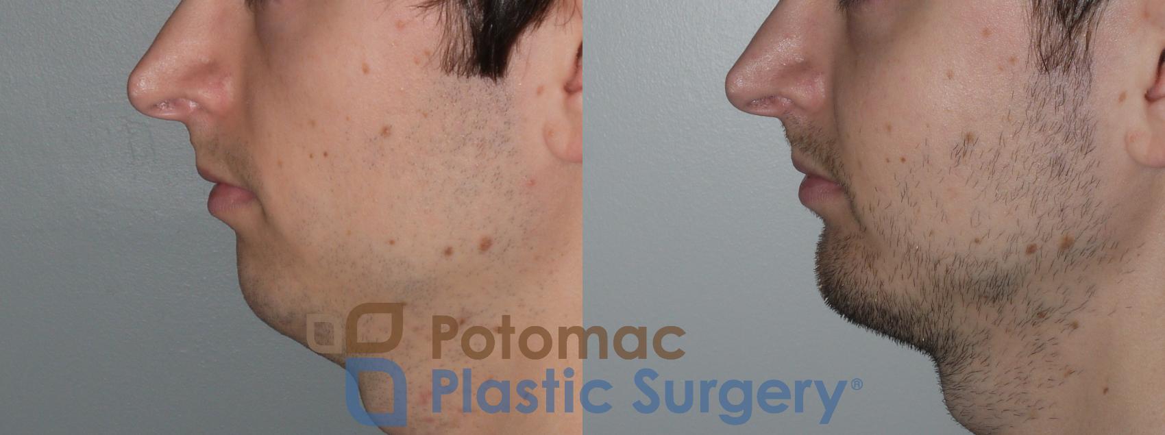 Before & After Chin Augmentation Case 135 Left Side View in Washington, DC