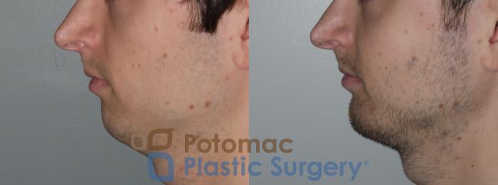 Before & After Facial Sculpting Case 135 Left Side View in Washington, DC