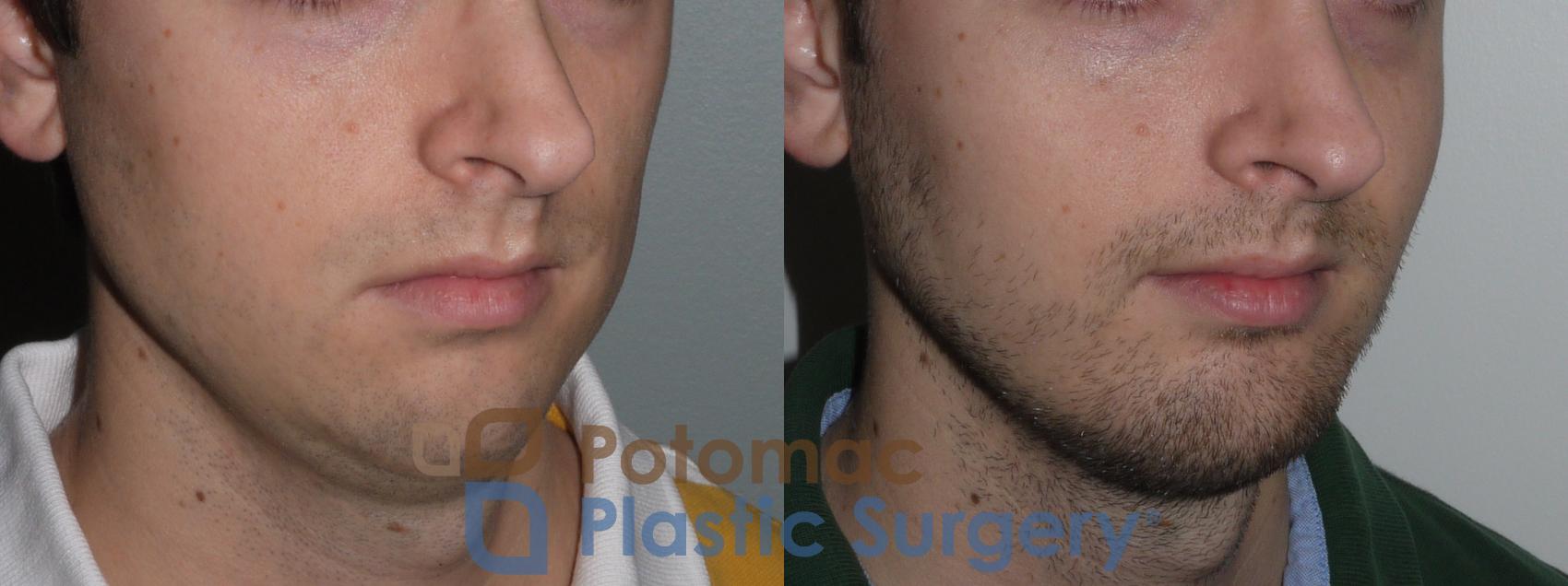 Before & After Chin Augmentation Case 135 Right Oblique View in Washington, DC