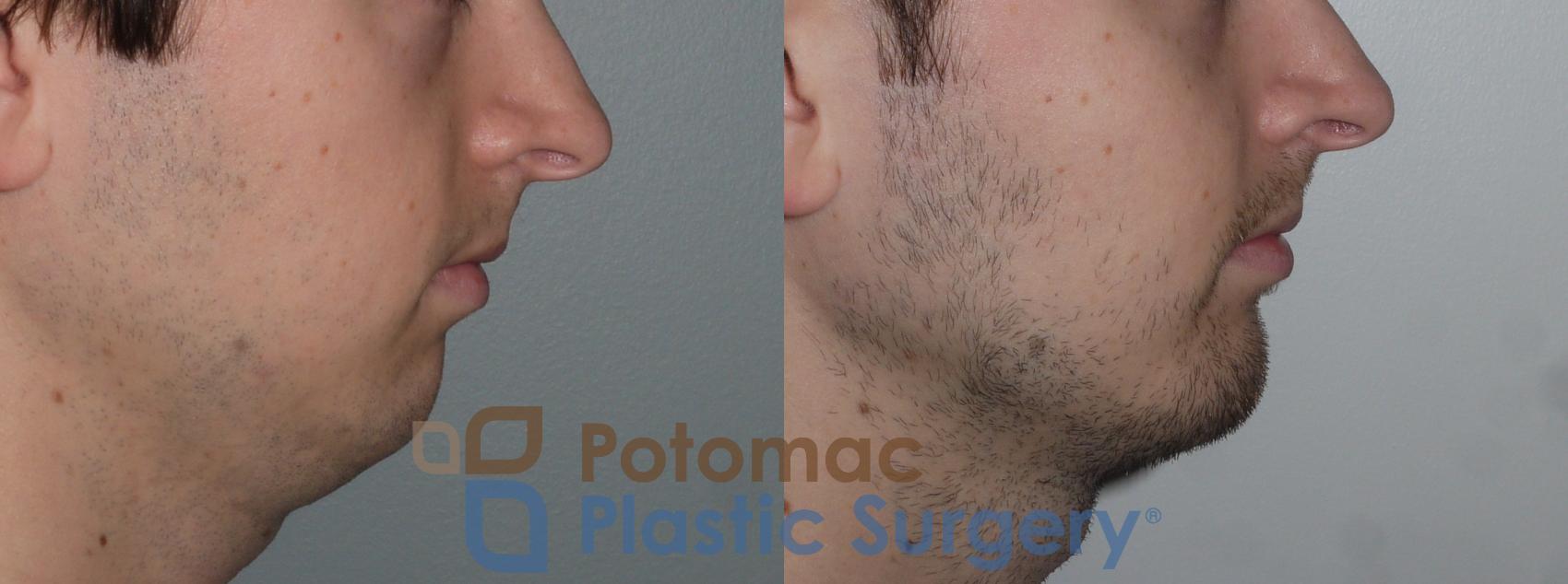 Before & After Chin Augmentation Case 135 Right Side View in Washington, DC