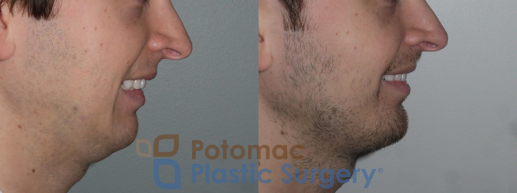 Before & After Facial Sculpting Case 135 Right Side View #2 View in Washington, DC