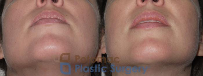 Before & After Liposuction Case 145 Below View in Washington DC & Arlington , DC