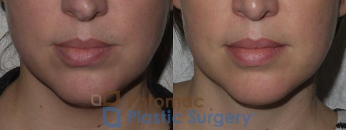 Before & After Liposuction Case 145 Front View in Washington DC & Arlington , DC