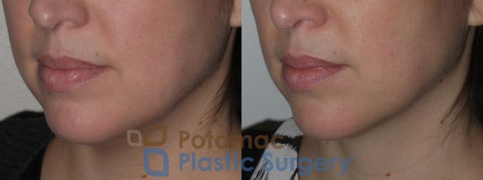 Before & After Liposuction Case 145 Left Oblique View in Washington DC & Arlington , DC