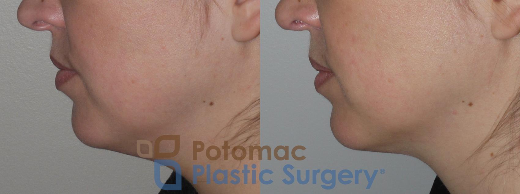 Before & After Facial Sculpting Case 145 Left Side View in Washington, DC