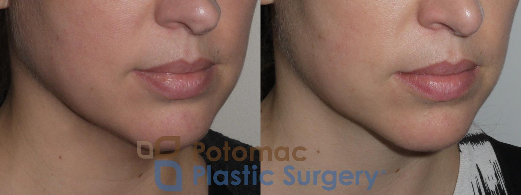 Before & After Facial Sculpting Case 145 Right Oblique View in Washington, DC