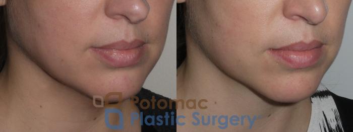 Before & After Liposuction Case 145 Right Oblique View in Washington DC & Arlington , DC