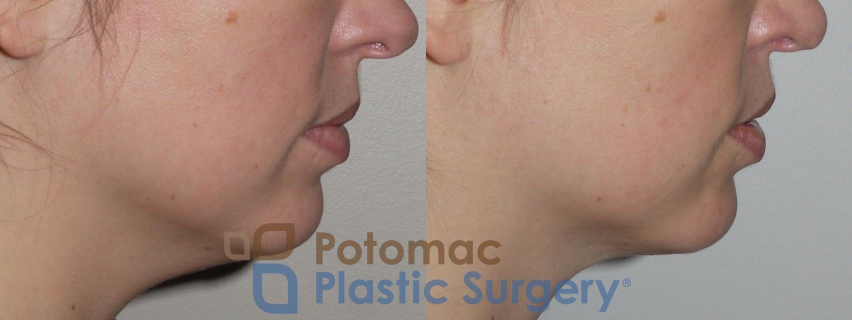 Before & After Facial Sculpting Case 145 Right Side View in Washington, DC