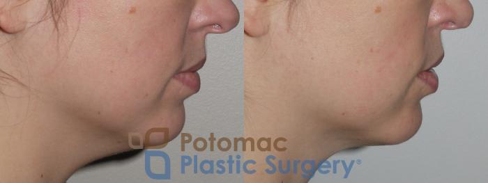 Before & After Liposuction Case 145 Right Side View in Washington DC & Arlington , DC