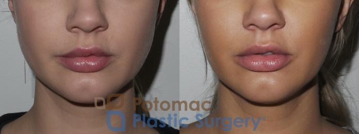 Before & After Facial Sculpting Case 155 Front View in Washington DC & Arlington , DC
