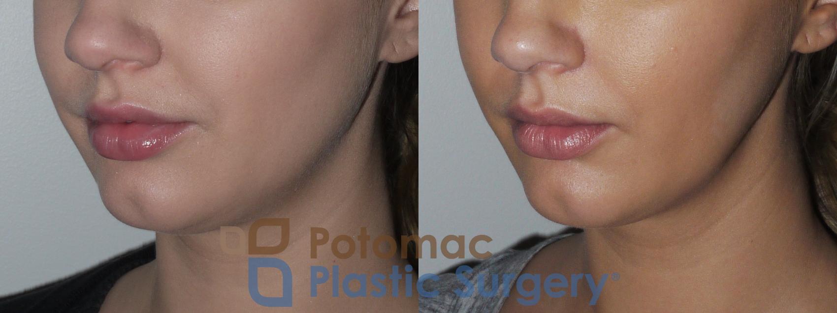 Before & After Facial Sculpting Case 155 Left Oblique View in Washington DC & Arlington , DC