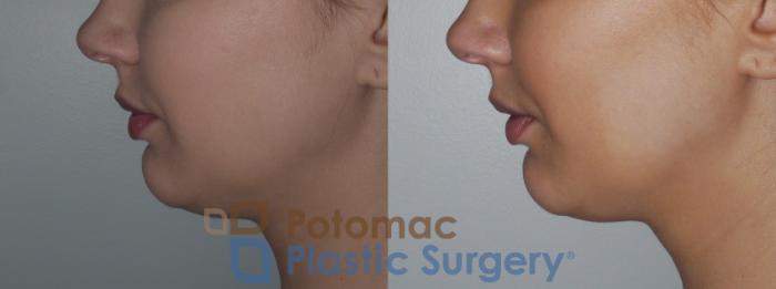 Before & After Botox Cosmetic Case 155 Left Side View in Washington DC & Arlington , DC
