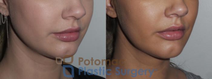 Before & After Facial Sculpting Case 155 Right Oblique View in Washington DC & Arlington , DC