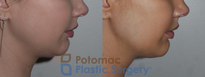 Before & After Botox Cosmetic Case 155 Right Side View in Washington DC & Arlington , DC
