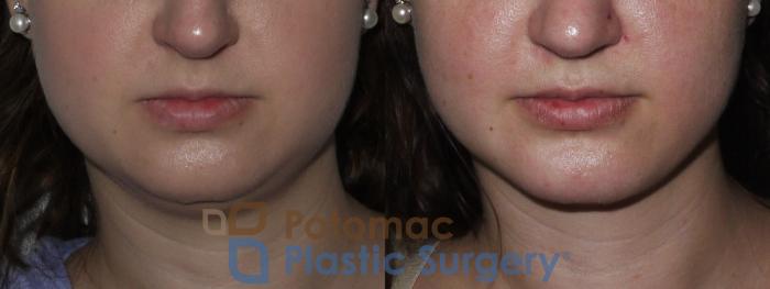 Before & After Chin Augmentation Case 156 Front View in Washington DC & Arlington , DC