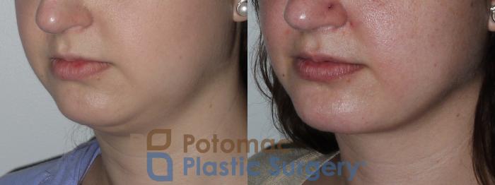 Before & After Liposuction Case 156 Left Oblique View in Washington DC & Arlington , DC