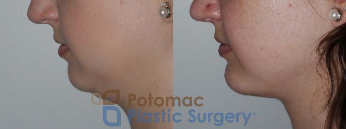 Before & After Chin Augmentation Case 156 Left Side View in Washington, DC