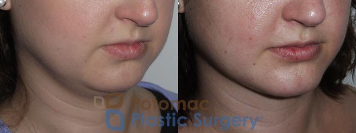 Before & After Liposuction Case 156 Right Oblique View in Washington DC & Arlington , DC