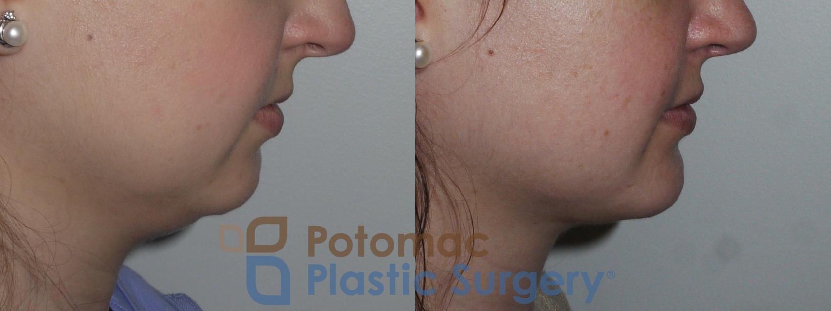 Before & After Facial Sculpting Case 156 Right Side View in Washington, DC