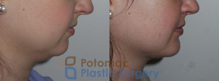 Before & After Chin Augmentation Case 156 Right Side View in Washington DC & Arlington , DC